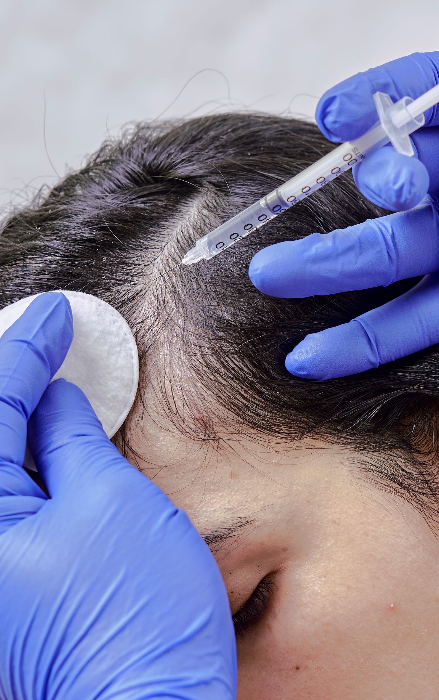 PRP for hair