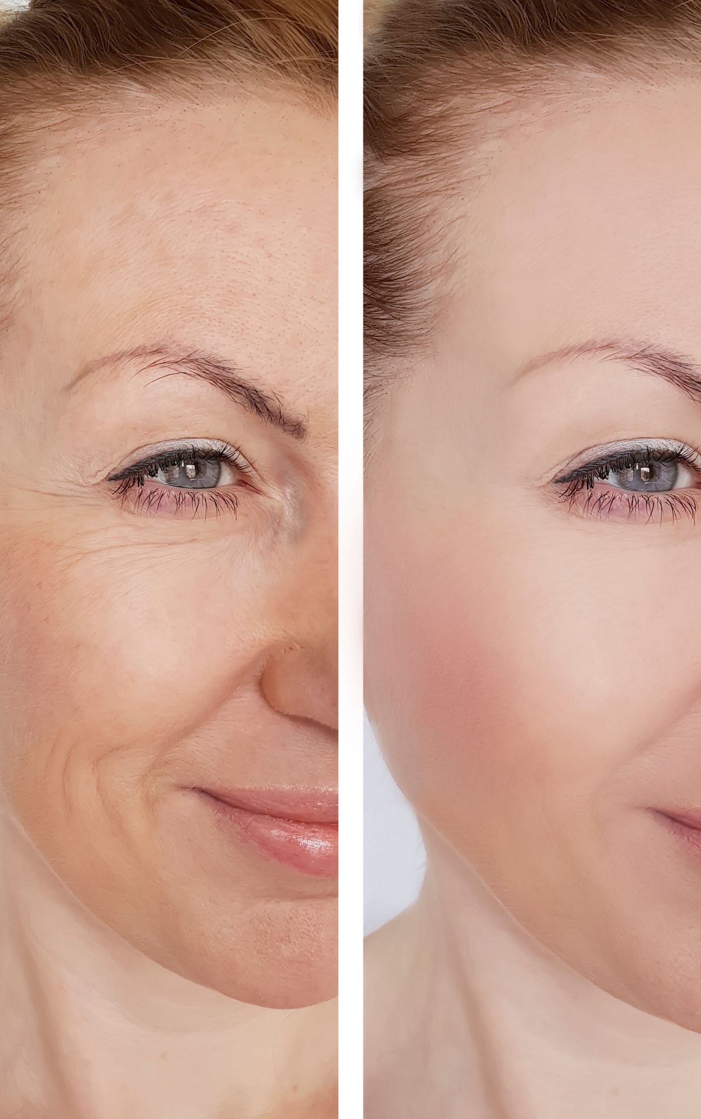 Exceed Microneedling